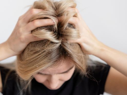 Droge hoofdhuid in de winter