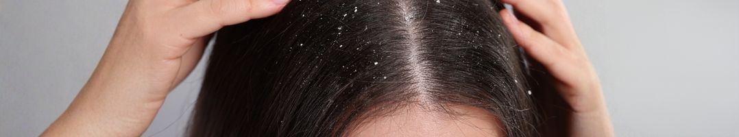 Droge hoofdhuid in de winter