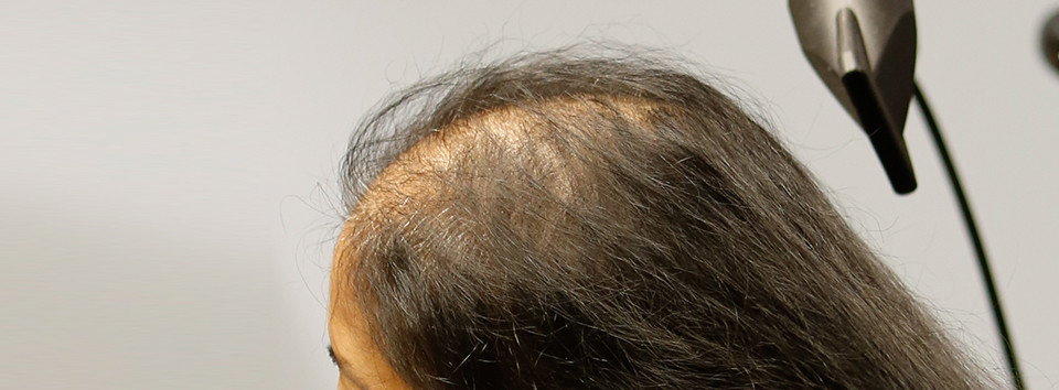Kaalheid midden op het hoofd Kaalheid midden op het hoofd