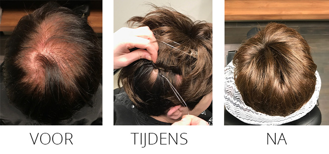 Wonderfill voor tijdens na Wonderfill voor tijdens na